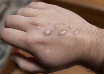 मंकिपक्स आशंका गरिएका व्यक्तिमा कुष्ठरोग