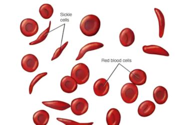 ‘सिकल सेल एनिमिया’ बाट पश्चिम तराईका १५ जिल्ला प्रभावित